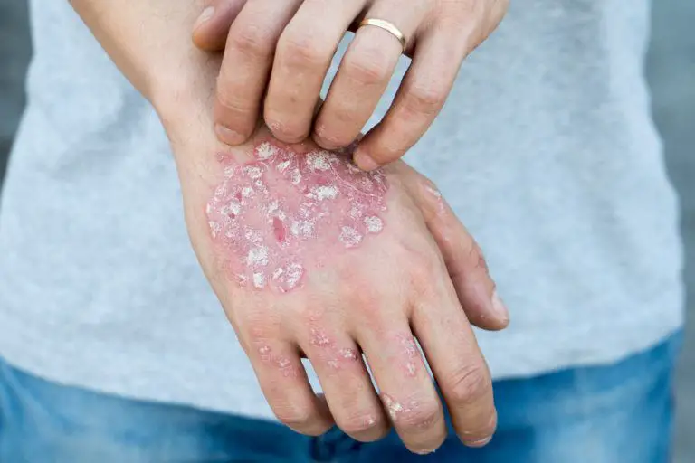 health_infections_skinfungus-768x512.jpg