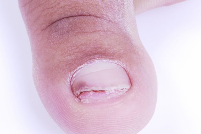 Ingrown Toenails