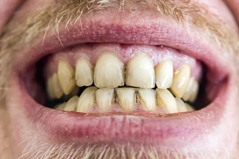 Stains on Teeth