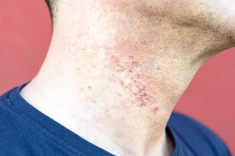 how-to-get-rid-of-razor-bumps