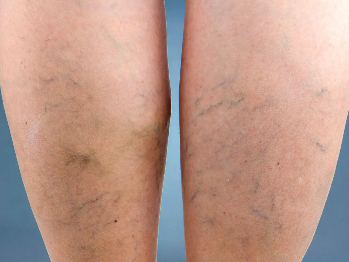 How to Get Rid of Spider Veins | GetRidofThings.com