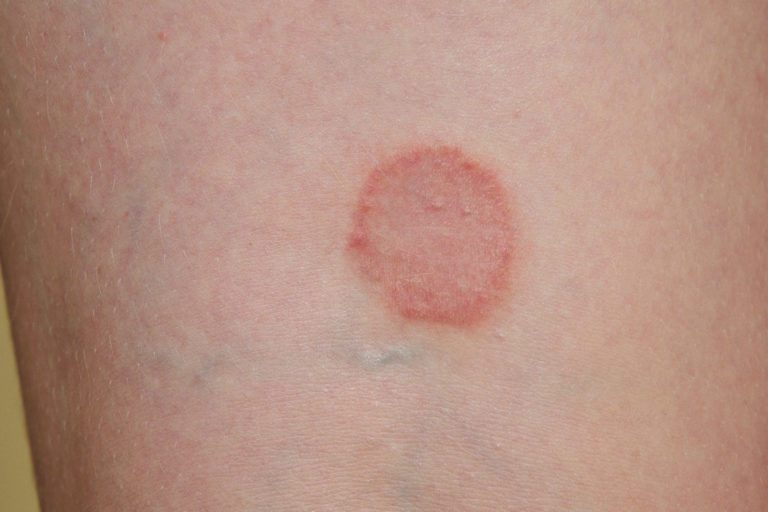 Pictures Of Healing Staph Infection PictureMeta