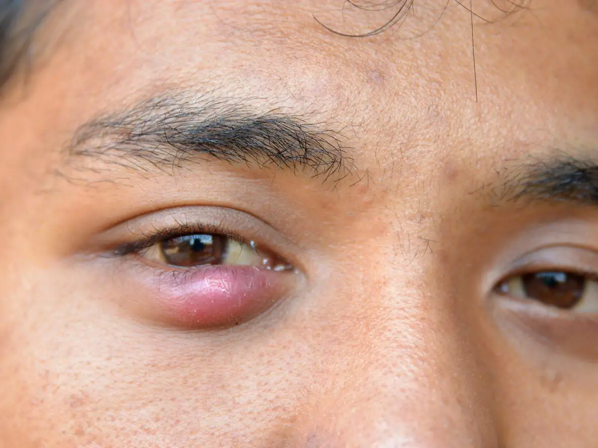 Can You Put Neosporin On Your Eyelid For A Stye How To Get Rid Of A Stye Getridofthings Com