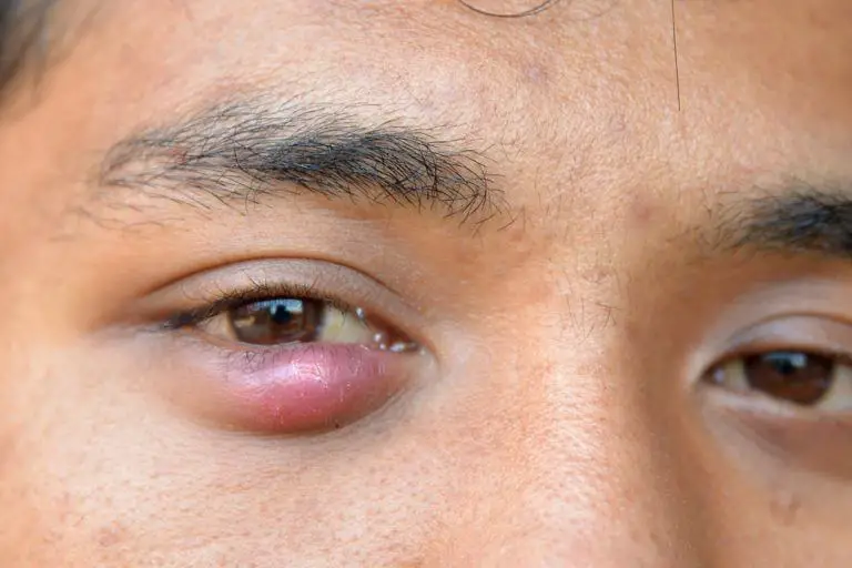 Can You Put Neosporin In Your Eye For A Stye How To Get Rid Of A Stye Getridofthings Com