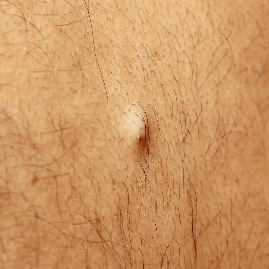 How To Get Rid Of A Cyst Getridofthings Com