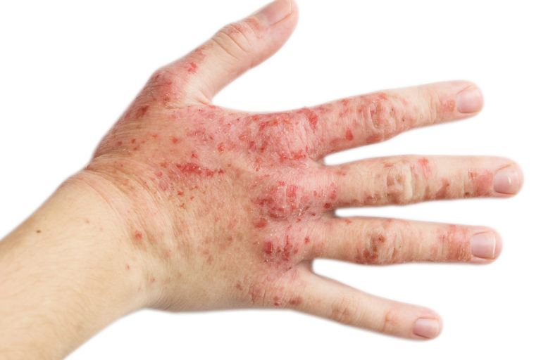 How To Get Rid Of Eczema Getridofthings Com