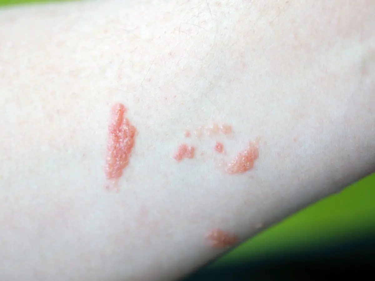 How To Get Rid Of Poison Ivy Rash,Poison Ivy Leaf Drawing