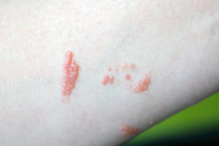 how-to-get-rid-of-poison-ivy-rash