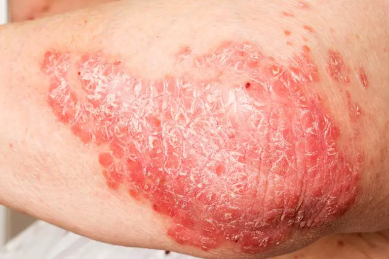 Psoriasis