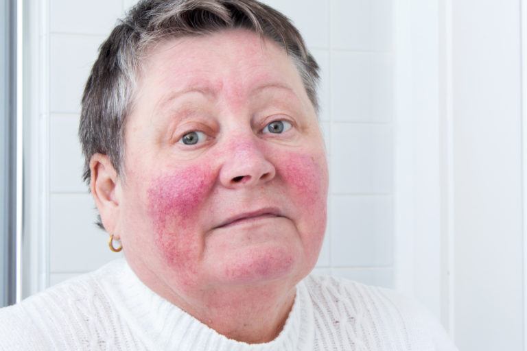 How to Get Rid of Rosacea