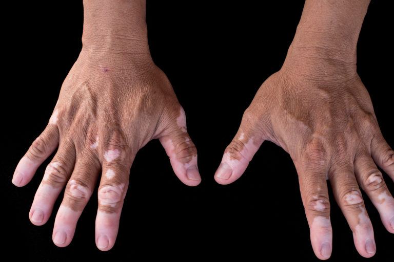 Vitiligo