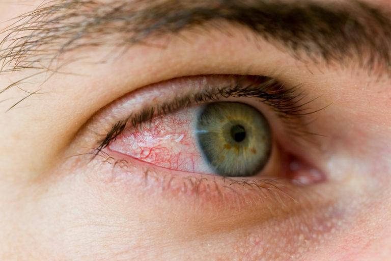 how-to-get-rid-of-bloodshot-eyes-without-eye-drops