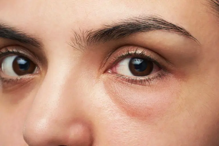 How To Get Rid Of Red Puffy Eyes From Allergies