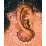 A keloid scar.