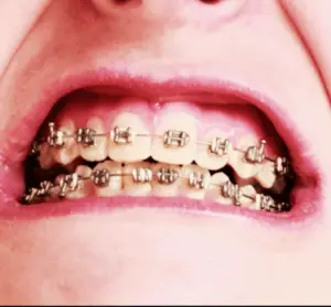 yellow teeth stain braces